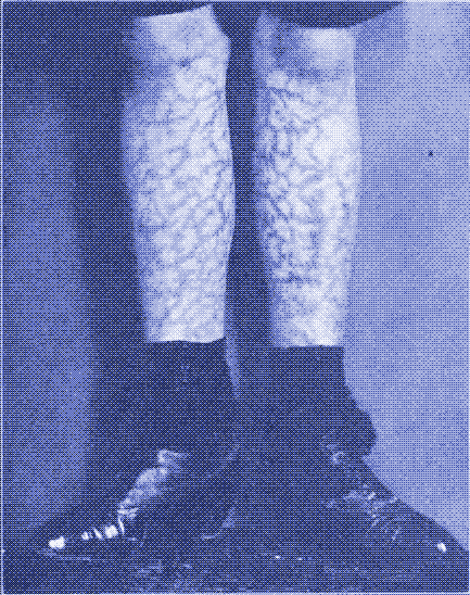 Una mujer de 22 años de edad con Síndrome de Piel Tostada, causada por una fuente de calor radiante de onda corta. Fuente: Diseases of the Skin (Enfermedades de la Piel), James H. Sequeira, 1915.